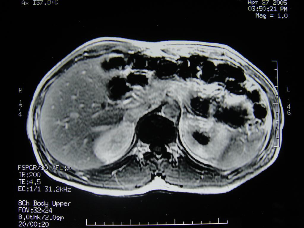 脂肪肝B超影像图-肝脏图片-中国脂肪肝防治与康复网