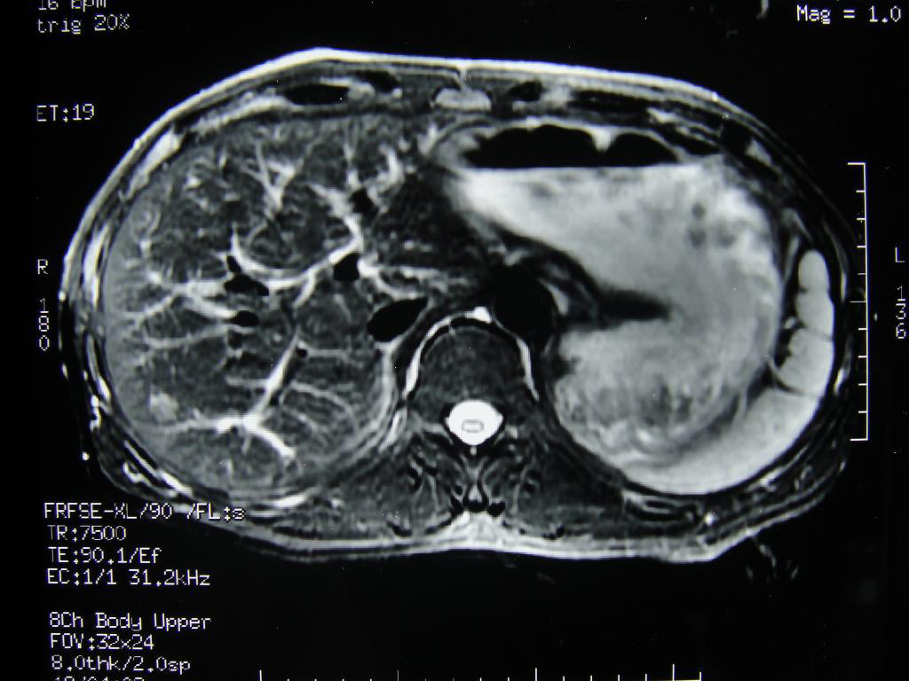 肝脏超声诊断典型图片赏析|肝脏|典型|图片|诊断|超声|II|-健康界